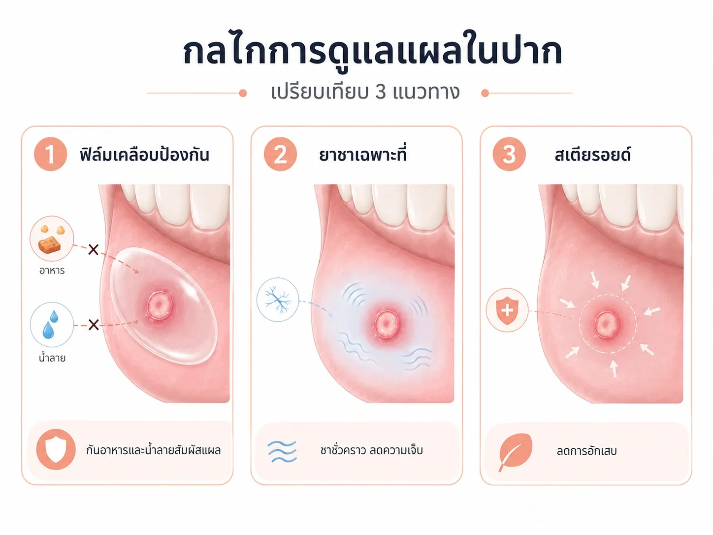 ภาพเปรียบเทียบแบบหนังสือแพทย์แสดงความแตกต่างระหว่าง Eureko Mouth Spray ยาชาเฉพาะที่ steroid paste benzydamine และสเปรย์สมุนไพร โดยเน้นกลไกและบทบาทการใช้งานของแต่ละกลุ่ม