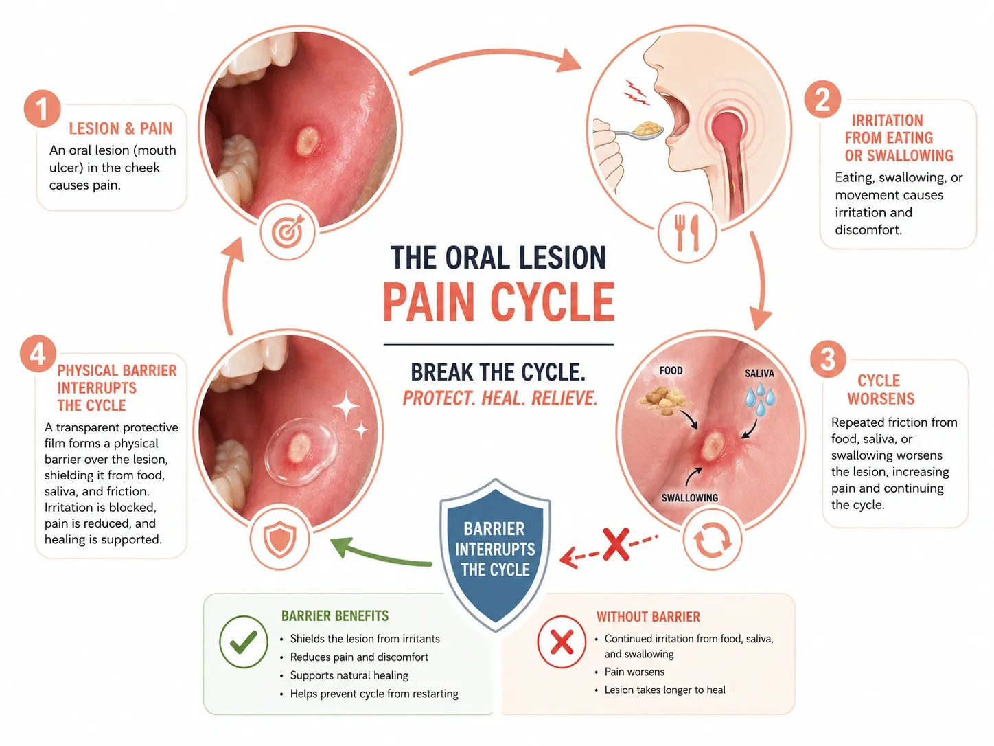 ภาพแผนภาพแบบหนังสือแพทย์แสดงลำดับเหตุผลทางคลินิกจาก painful oral lesion ไปสู่การเกิดการกระตุ้นซ้ำเวลารับประทาน และบทบาทของฟิล์มเคลือบแผลในการลดการกระตุ้นดังกล่าว